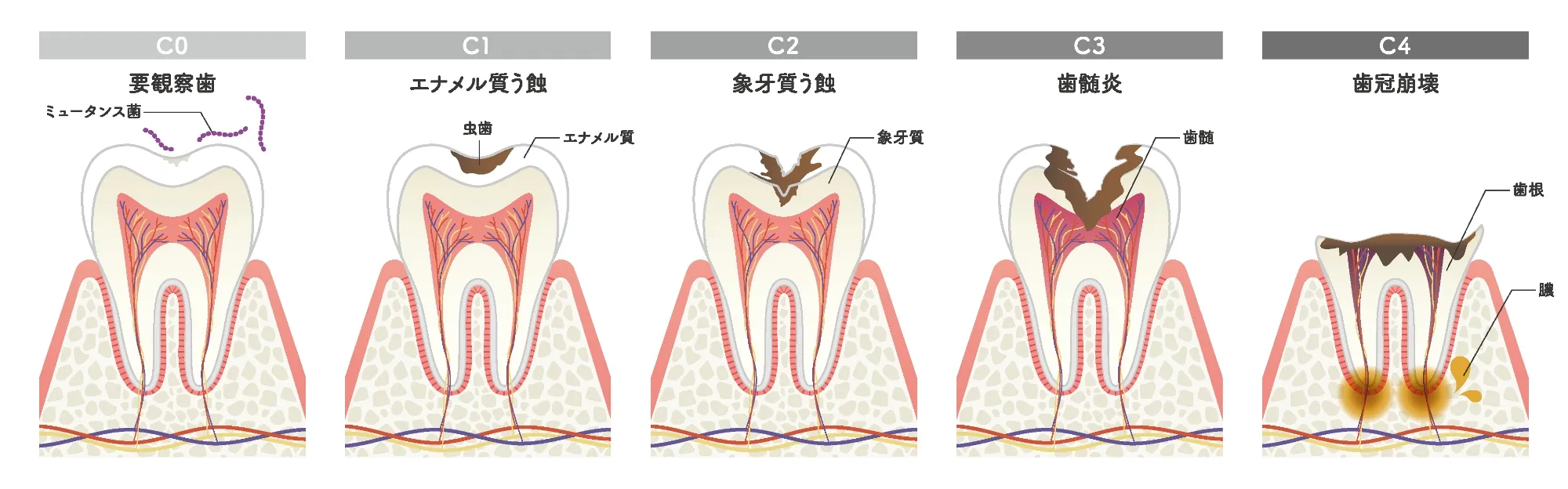 虫歯の進行