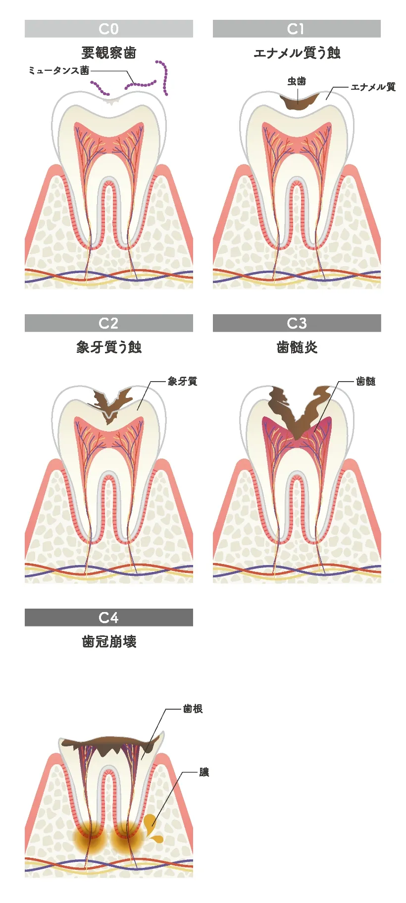 虫歯の進行