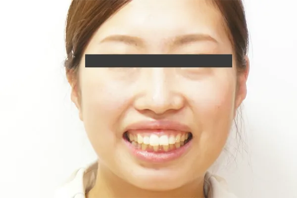 抜歯基準 画像4