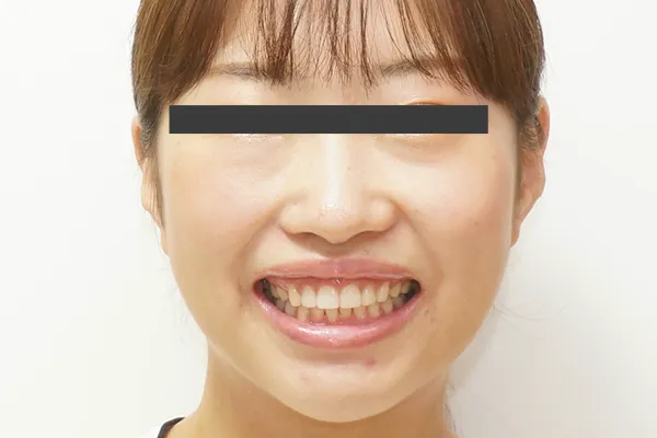 抜歯基準 画像11