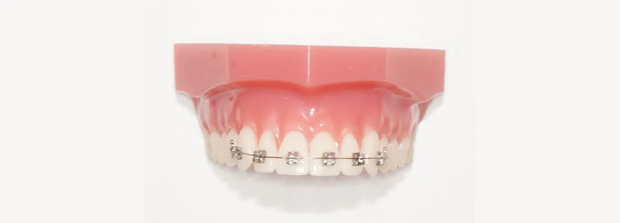 CASE1 上顎:表側 メタル 6本