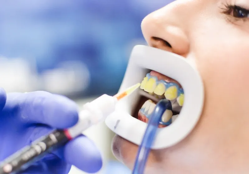 ホワイトニング薬剤を塗布する