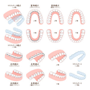矯正装置にはどんな種類がある？