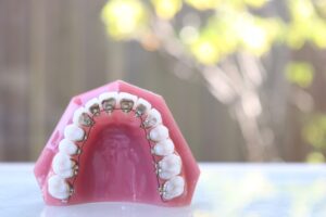 裏側矯正ってなに？目立ちにくい裏側矯正について解説！